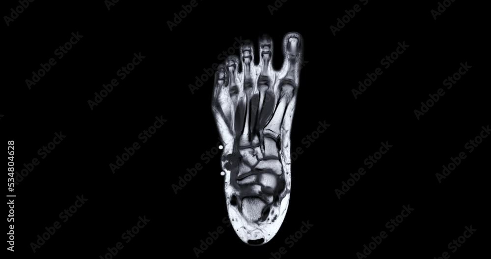 Poster mri foot scan for a diagnostic tool used to image the structures of the foot and ankle following sym