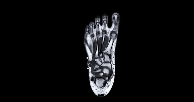 MRI foot scan for a diagnostic tool used to image the structures of the foot and ankle following symptoms: pain  both feet, swelling, redness or warmth, numbness or tingling and stiffness.
