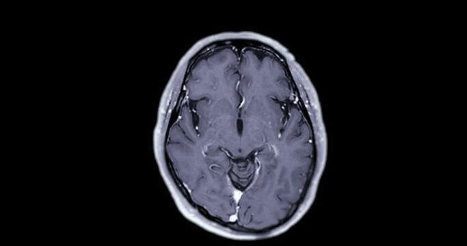 MRI of the brain with gadolinium contrast media for diagnosis brain tumor and stroke diseases . magnetic resonance imaging of the brain.