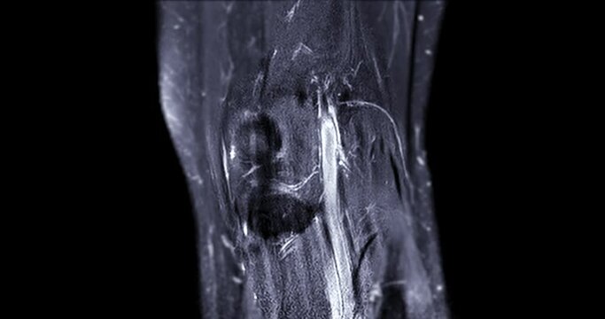 MRI Knee joint or Magnetic resonance imaging  for detect tear or sprain of the anterior cruciate  ligament (ACL).