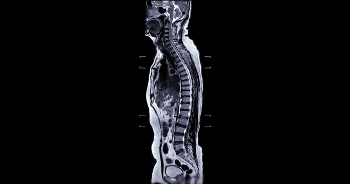 MRI Screening whole spine T2 for diagnosis  spinal cord stenosis.