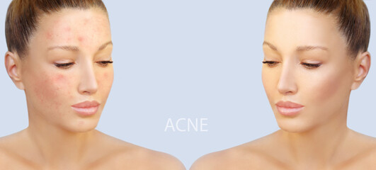 Post-Acne Marks .Treating Acne Scars.Acne Scar Removal.