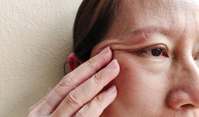 portrait the fingers holding the flabbiness adipose sagging skin beside the eyelid, cellulite and...