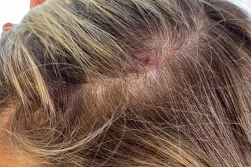  Psoriasis of the scalp , psoriatic redness, peeling and crusts on the scalp of an unrecognizable...