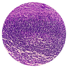 Photomicrograph of lymph node with Hodgkin's Disease (lymphoma), nodular sclerosis. showing polymorphous population of lymphocytes, histiocytes, mononuclear cells and eosinophils by fibrous bands.