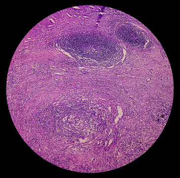 Photomicrograph of lymph node with Hodgkin's Disease (lymphoma), nodular sclerosis. showing polymorphous population of lymphocytes, histiocytes, mononuclear cells and eosinophils by fibrous bands.