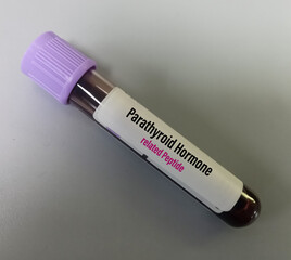 Blood test sample for Parathyroid Hormone related peptide(PTHrp) test which secreted by mesenchymal stem cells. Parathyroid hormone-related protein test.