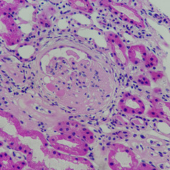 Camera photo of focal segmental glomerulosclerosis, showing segmental obliteration of capillary...