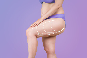 Legs and buttocks liposuction, fat and cellulite removal concept, overweight female body with...