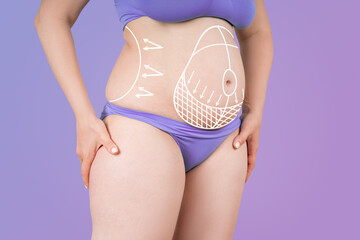 Abdomen liposuction, fat and cellulite removal concept, overweight female body with painted surgical lines and arrows