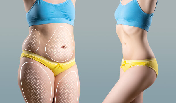 Tummy tuck, cellulite removal, woman's body before and after liposuction on gray background, plastic surgery concept