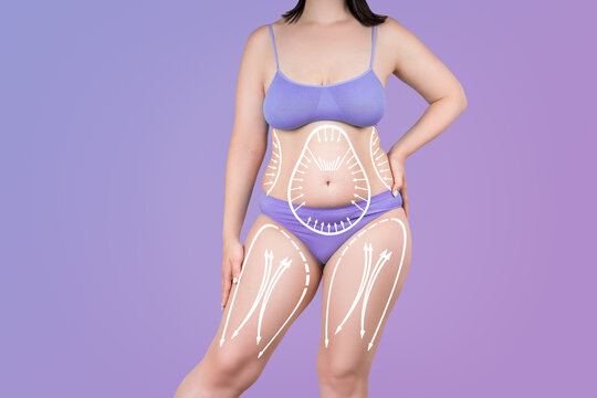 Legs and belly liposuction, fat and cellulite removal concept, overweight female body with painted surgical lines and arrows