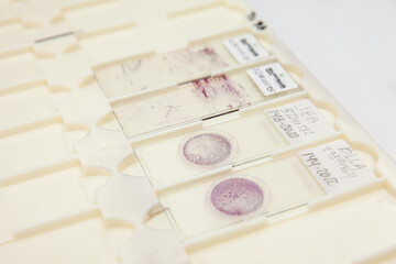 Traditional and liquid based cytology microscope slides for pap smear test. Cervical cancer...