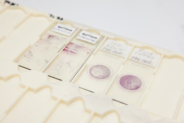 Fototapeta premium Traditional and liquid based cytology microscope slides for pap smear test. Cervical cancer concept. Medical concept.