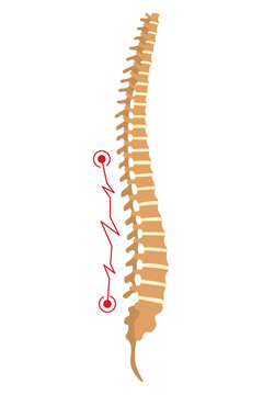 Spinal deformity. Symbol of spine curvatures or unhealthy backbones. Human spine anatomy, curved spine. Diagram with marked section. Body posture defect
