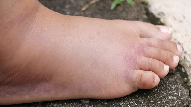 close up of women feet with swelling 