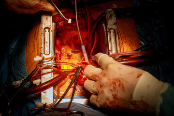 Valve replacement is performed in operating room when a malfunctioning valve the heart causes an...