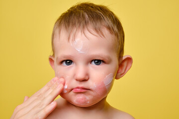 Mother smears allergy cream on face of toddler baby, studio yellow background. Close-up portrait of...