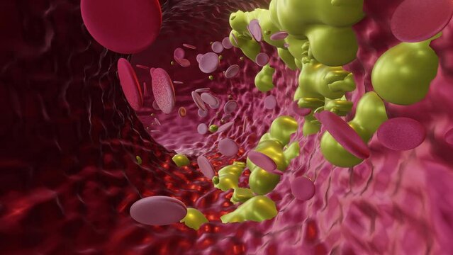 Cholesterol Buildup Blood Vessel (Closeup)
