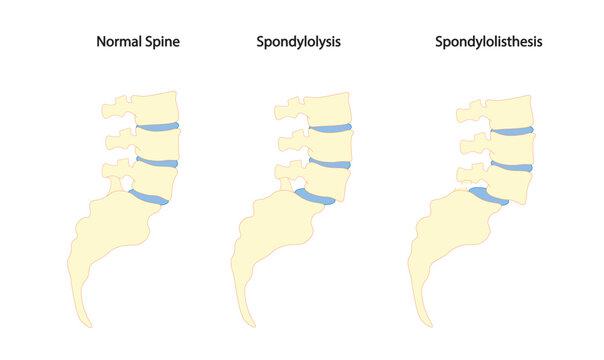 Spondylolysis and Spondylolisthesis illustration. Spine and sacral lateral view. 