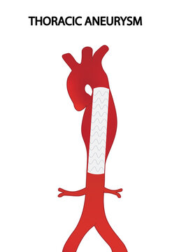Endovascular thoracic aneurysm repair illustration