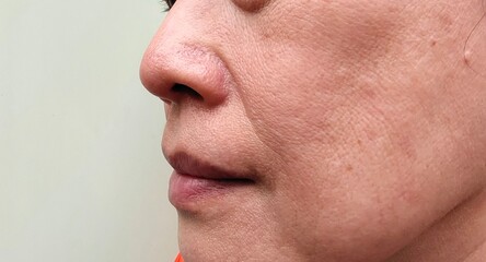 Portrait showing the flabbiness adipose sagging skin, dark spots and blemish on the cheek, dull skin and wrinkles corner of the mouth, Flabby skin on the face of the woman, concept health care. - obrazy, fototapety, plakaty