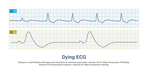 Fototapeta premium Electromechanical separation is an ECG of cardiac arrest. The heart has only electrical activity, but no mechanical activity. It needs to be differentiated from ventricular escape rhythm.