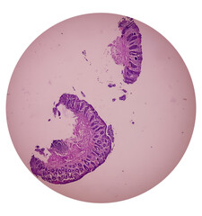 Tissue from rectum(colonoscopic biopsy):  Chronic nonspecific proctitis. Show rectal mucosa, dense...