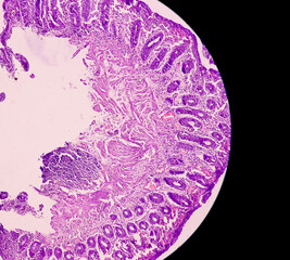 Tissue from rectum(colonoscopic biopsy):  Chronic nonspecific proctitis. Show rectal mucosa, dense infiltration of lymphocytes, histiocytes and plasma cell in lamina propria. IBD.