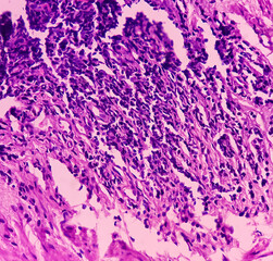 Tissue from rectum(colonoscopic biopsy):  Chronic nonspecific proctitis. Show rectal mucosa, dense...