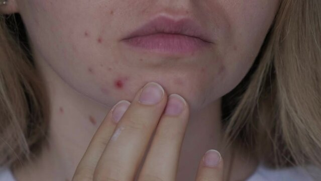 Unrecognizable woman showing her acne on face. Close-up acne on woman's face with rash skin ,scar and spot that allergic to cosmetics. Problem skincare and health concept. Wrinkles, melasma, dark