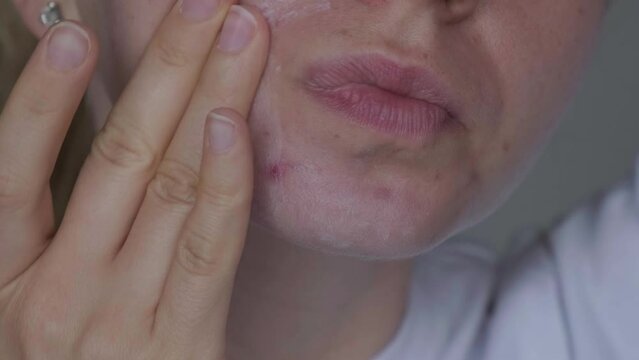 Unrecognizable woman applies makeup, cream serum cure for acne on face. Close-up acne on woman's face with rash skin ,scar and spot that allergic to cosmetics. Problem skincare and health concept