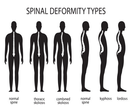 Deformity And Variations In The Spine.