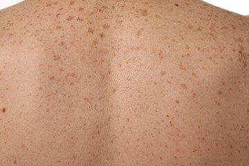Closeup of man's body with birthmarks as background