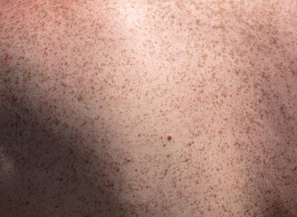 Freckle on the back of a man.