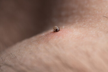 Sucking tick Macro photo on human skin. Ixodes ricinus. Bloated parasite bitten into pink irritated...