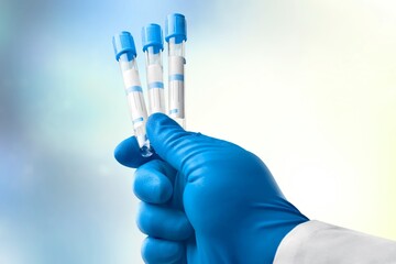 Doctor holding a test tube with blood on gradient background. Infected people concept.