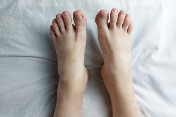 Pregnant woman with swollen legs, foot pain. Lies on the bed in the room.
