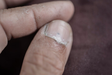 close up Problematic nails that are damaged by fungus	