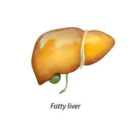 Fatty liver, liver steatosis, 3D illustration and photomicrograph showing large vacuoles of triglyceride fat accumulated inside liver cells, it occurs in alcohol overuse, under action of toxins - obrazy, fototapety, plakaty