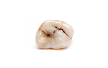 Close-up of a tooth with caries isolated on a white background. Removed wisdom teeth. Sick human...