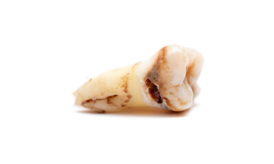 Close-up of a tooth with caries isolated on a white background. Removed wisdom teeth. Sick human teeth.