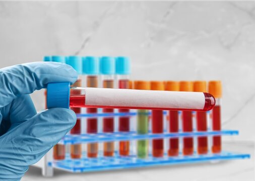 Blood sample tube for Monkeypox virus test. stranded DNA, zoonotic virus and a species of the genus Orthopoxvirus in the family Poxviridae - Powered by Adobe