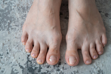 person feet close up, fungus, broken nail, skin infection, toe mycosis, treatment needed, fungal infection concept, onychomycosis, onycholysis, nail separates from nail bed, separated 