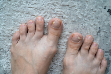 person feet close up, fungus, broken nail, skin infection, toe mycosis, treatment needed, fungal...