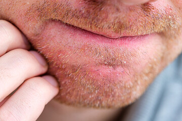 Seborrheic dermatitis or eczema on adult man face isolated close up.