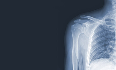 x-ray images of the shoulder joint to see injuries bones and tendons for a medical...