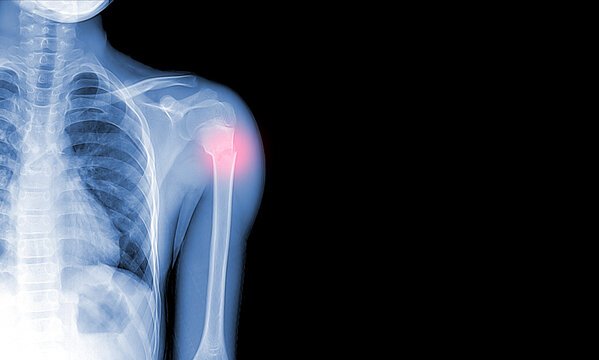 x-ray images of the shoulder joint to see injuries bones fractures and tendons for a medical diagnosis.Medical image concept and copy space.