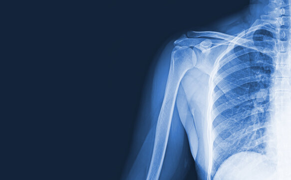 X-ray Images Of The Shoulder Joint To See Injuries Bones And Tendons For A Medical Diagnosis.Medical Image Concept And Copy Space.