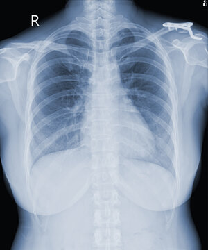 x-ray images Chest and shoulder joint modified coracoclavicular stabilizer to see injuries bones and tendons for a medical diagnosis.Medical image concept.